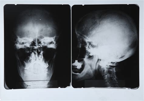 Albert Einstein Brain X Ray Two Views
