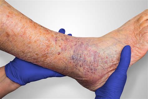 Lower Extremity Wounds And The Treatment And Management Of Venous