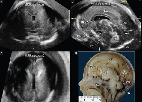 Assessment Of Fetal Midbrain And Hindbrain In Mid‐sagittal Cranial