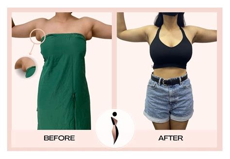 Armpit Fat Removal Accessory Breast Tissue Removal
