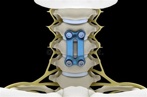 X Ray 3d Image Of Cervical Spine With Prolapse Of Intervertebral Disc