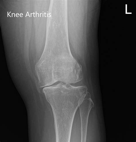 Case Study Customized Total Knee Replacement In A 59 Year Old Male