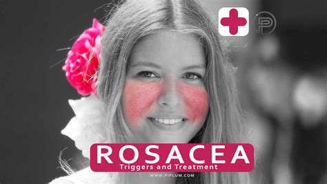 What Are The Symptoms Of Rosacea What Are The Triggers And Risk Factors