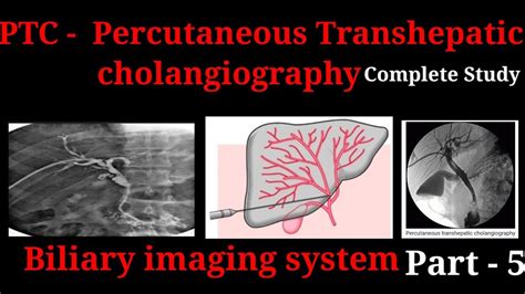 Percutaneous Transhepatic Cholangiography Ptc Procedure Biliary