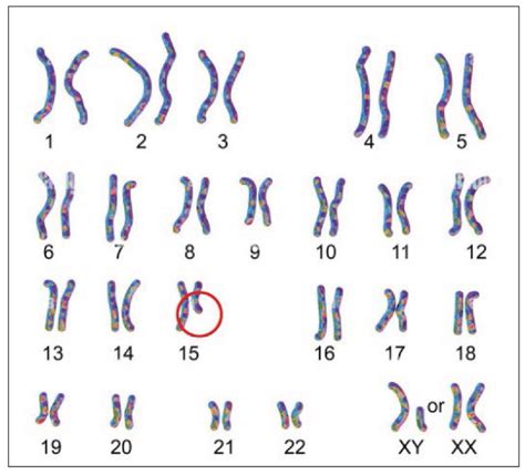 The Karyotype Image Showing Chromosomal Abnormality In Pws Disease Note