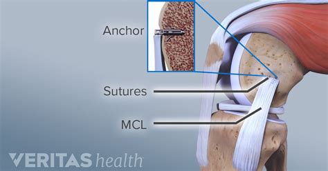 Treatment Options And Recovery For Mcl Sprains And Tears