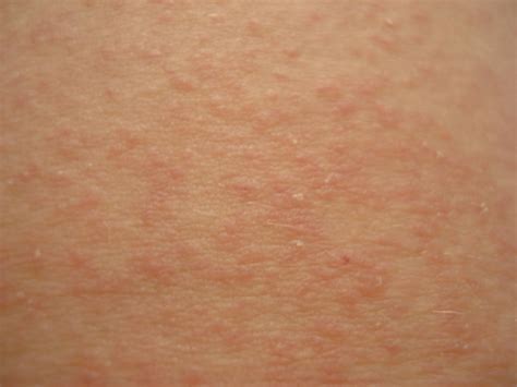 Heat Rash Chlor Itch How To Solve Before I Go Crazy Health And