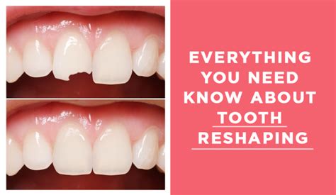 Everything You Need To Know About Tooth Reshaping Top Cosmetic