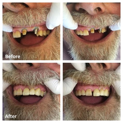 Tooth Crowns And Dental Bridges Ottawa Restorative Dentistry