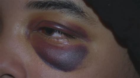 Teen Suffers Broken Eye Sockets After Brutal Attack Abc13 Houston