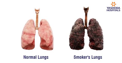Unveiling The Damage Smoking And Lung Health Insights