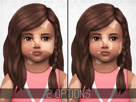 Sims 4 Vitiligo Skin Sims 4