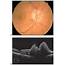 Nonarteritic Anterior Ischemic Optic Neuropathy NAION  American