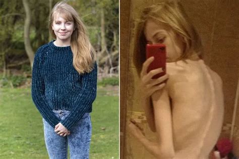 Teenage Anorexic Plummeted To Five And A Half Stone After Surviving On Just Calories A Day