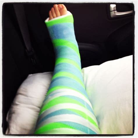 Top 104 Wallpaper Picture Of A Leg In A Cast Latest