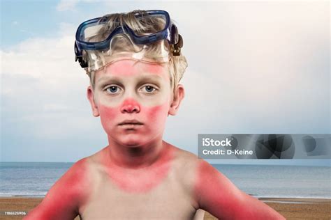 Sunburned Boy Stock Photo Download Image Now Sunburned Child