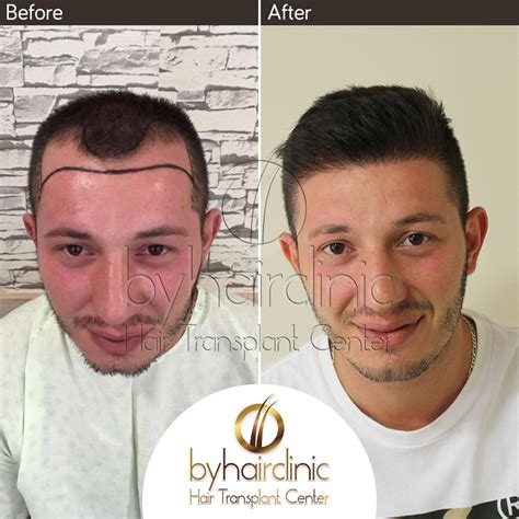 Fue Hair Transplantation Turkey Bysacekimi Hair Transplantation In