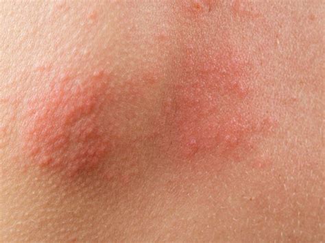 Effective Tips For Managing Shingles