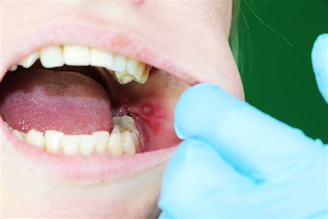 what causes mouth sores and infections