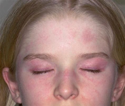 Juvenile Dermatomyositis Jdm Symptoms Causes Diagnosis And Treatment