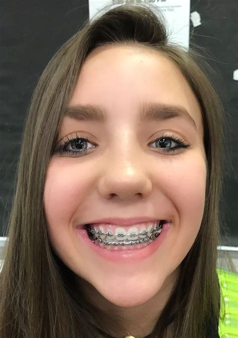 Cute Girl Braces For Teeth Telegraph