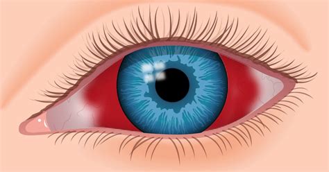 Retinal Hemorrhage Bleeding From Blood Vessels In The Retina Inside