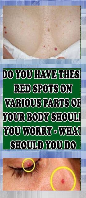Do You Have These Red Spots On Various Parts Of Your Body