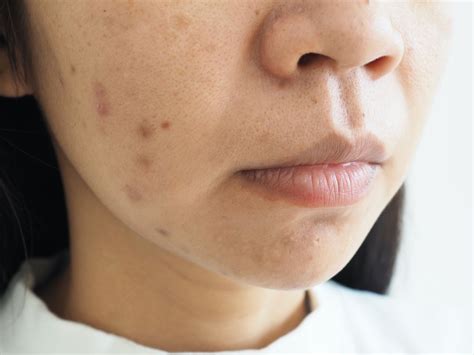 How To Treat Post Inflammatory Hyperpigmentation Caused By Acne The