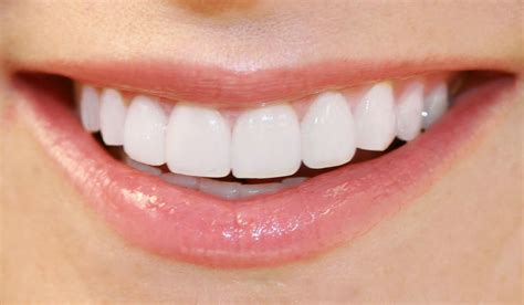 Are You Looking For Best Teeth Wightining Dental In Carlingford Oatland And Near By Areas