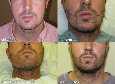 The goal was to compensate for further thinning in the forelock, to extend the transplant further towards the back, and to add more fullness overall. Facial Hair Transplant - Before and After Pictures * | Dr ...