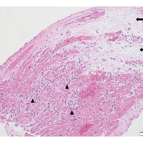 Endomyocardial Biopsy Showing Evidence Of Acute Necrotizing Myocarditis