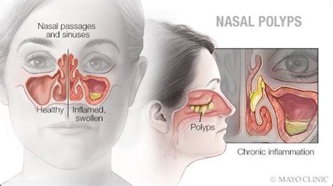 Mayo Clinic Q And A Understanding Nasal Polyps Mayo Clinic News Network