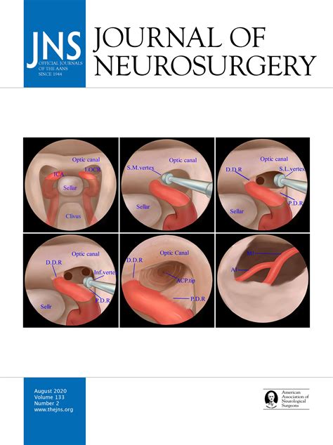 Significance Of Degree Of Neurovascular Compression In Surgery For