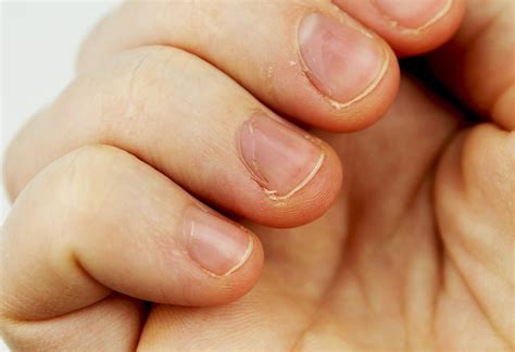What Deficiency Causes White Spots In Nails Design Talk