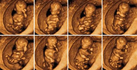 4d Us Imaging Demonstrated Fetus At 13 Weeks Of Gestation Showing