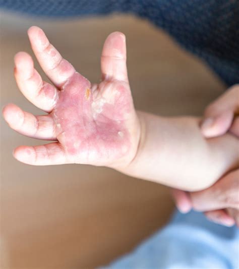 Burns In Children Treatment And Home Remedies