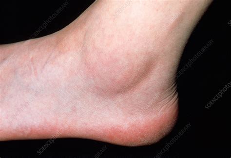 Sprained Ankle Stock Image M3300887 Science Photo Library