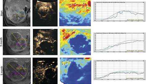 Quantification Of Dynamic Contrast Enhanced Ultrasound In Hcc