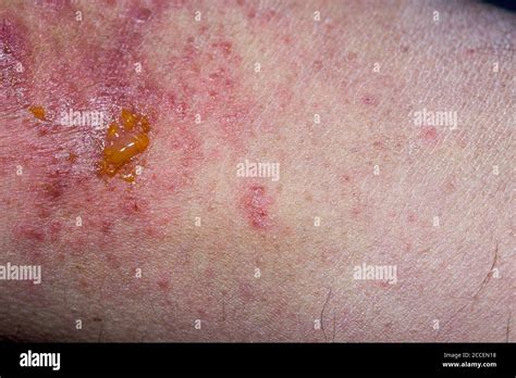 Atopic Dermatitis High Resolution Stock Photography And Images Alamy