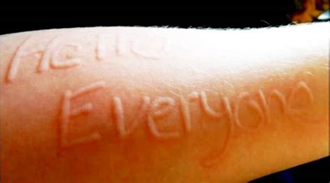 Yes There Is A Condition That Lets You Write On Your Skin