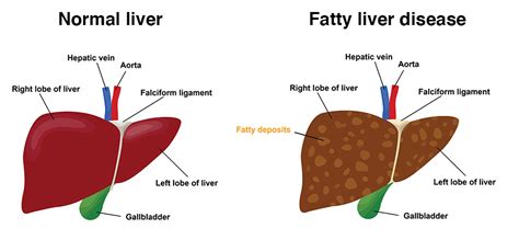 How To Check For Fatty Liver Askexcitement5