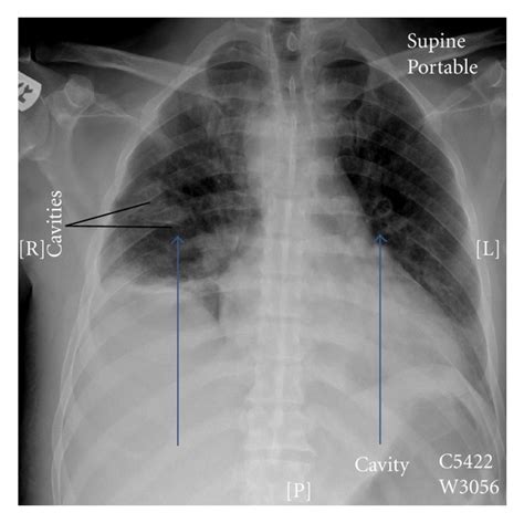 Lung Abscess Chest X Ray Sexiz Pix