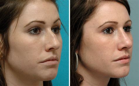 The next one is in a few weeks. Rhinoplasty Before & After Photos | Annapolis MD Nose Job