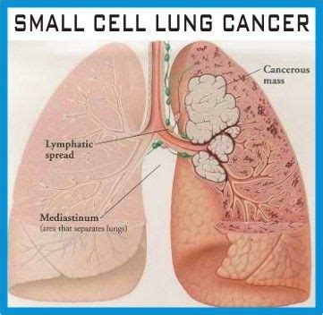 In stage 4, the cancer has spread, or metastasized, beyond the lungs into other areas of the body. Is Stage 4 Lung Cancer Curable - Cancer News Update