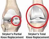 Photos of Partial Vs Total Knee Replacement Recovery