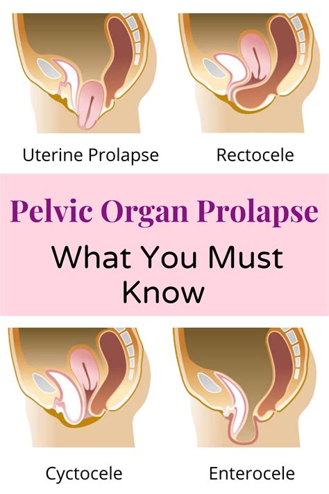 Everything You Need To Know About Pelvic Organ Prolapse Pelvic Organ