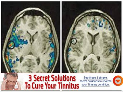 Can Acupuncture Help Pulsatile Tinnitus Healthy Tips