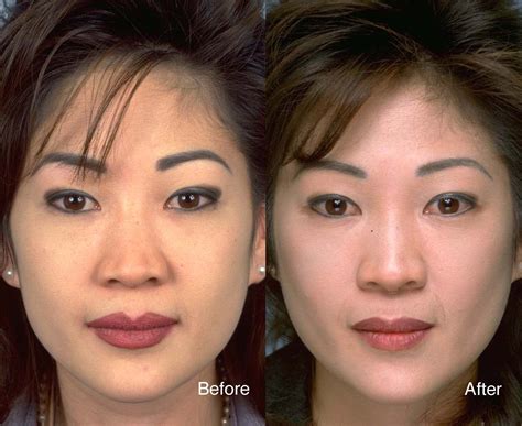 Facelift Case Studies Beverly Hills Facial Tightening Patient Studies