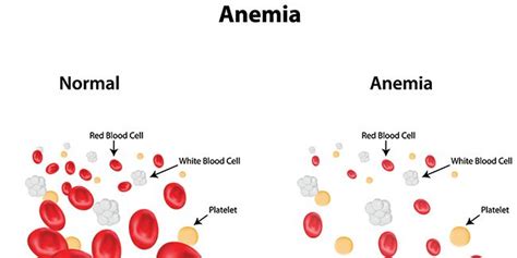 Анемија симптоми причини лекување Panaceamk