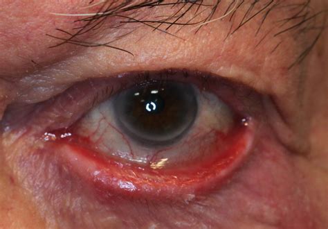 Severe Ectropion Of Lower Eyelid